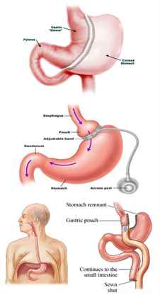 Weight Loss Surgery: Getting Thin Abroad